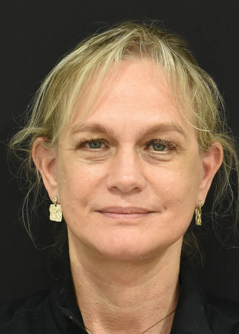 Deep Plane Facelift Patient 32 Set 1 After